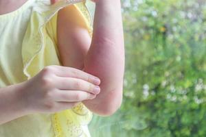 Little girl has skin rash allergy and itchy on her arm photo