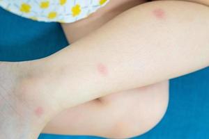 Little girl has skin rash allergy itching on her leg photo