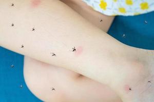 Little girl has skin rash allergy itching on her leg with mosquitoes bite photo