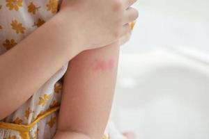 Little girl has skin rash allergy itching and scratching on her arm photo