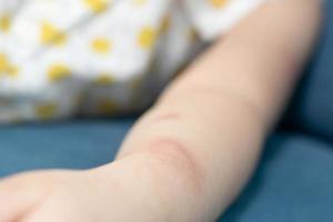 Little girl has skin rash allergy itching and scratching on her arm photo