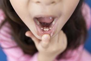 dientes de leche en la boca de una niña de 6-7 años, lo balancea con el dedo, vista de cerca de la boca abierta. pérdida de dientes por concepto de edad. reemplazo de dientes permanentes. foto