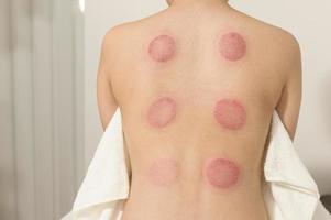 Beautiful Woman Received cupping treatment on back by  therapist, chinese medicine treatment, health and healing concept. photo