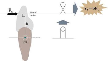 Orthodontic forces on the dental crown and the resultant torque vector