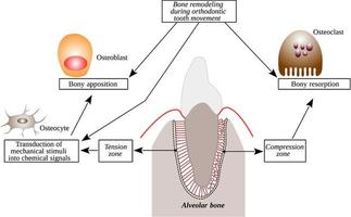 remodelación ósea durante el movimiento dental de ortodoncia - formación ósea y hueso vector