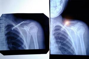 Two X ray images man with fractured collarbone and an inserted space after surgery. photo