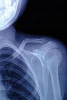 X-ray image broken collarbone person. photo