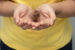 pérdida de cabello de la mujer por alergia al champú. foto