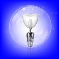 Realistic white dental implant on a blue background in a luminous circle with highlights. Vector 3d tooth model with thread.