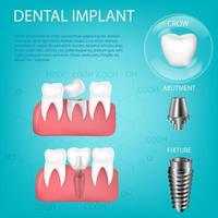 Vector realistic, 3D set of dental implants with installation in the gum. Structural elements of dental implant isolated with text.