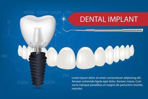 Realistic white dental implant on a blue background with beautiful teeth mockup. Vector 3d model of an implant with thread and inscription.