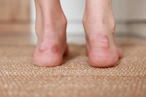 Callus blisters on woman feet. Painful wounds. Uncomfortable shoes problems. View of foot with inflammatory corns. Health and beauty concept. photo