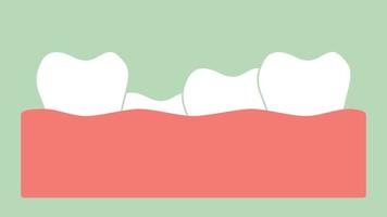 apiñamiento de dientes o maloclusión - dibujos animados dentales vector estilo plano renderizar animación de metraje 2d, en formato de video de ultra alta definición 4k y uhd 3840x2160