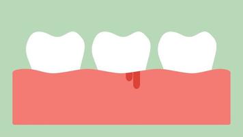 gengivite ou doença gengival com sangramento, inflamação gengival antes da doença periodontal - animação de filmagem 2d estilo plano vetorial de desenho dental, em formato de vídeo de ultra alta definição 4k e uhd 3840x2160 video