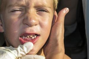 boca abierta de un niño con dientes de crecimiento incorrecto, caries de dientes de leche, dientes de leche extraídos, odontología y atención médica foto