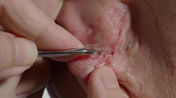 Squeezing blackhead pimple with stainless steel medical acne remover tool.