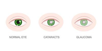 Healthy, cataract and glaucoma eye closeup view. Eyeball with normal and unhealthy lens. Aging visual problems concept. Anatomically detailed human organ of vision vector