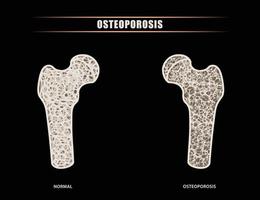 ilustración de un fémur humano versus comparación intraarticular de cadera de síntomas óseos normales con osteoporosis. vector