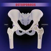 Ilustración 3d de un hueso de la cadera humana que compara el interior de los síntomas óseos normales con la osteoporosis. vector