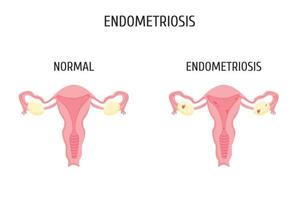 Female genital organs with and without endometriosis. Infographics. vector