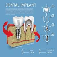 dientes humanos y vector de implante dental en maqueta de encías.