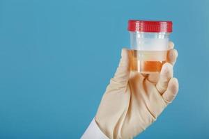 A container for biomaterial with a urine analysis in the hand of a doctor in a white rubber glove on a blue background. photo