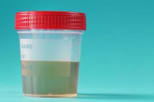 A container for biomaterials with a urine analysis and a red lid on a cyanic background. photo