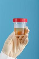 A container for biomaterial with a urine analysis in the hand of a doctor in a white rubber glove on a blue background. photo