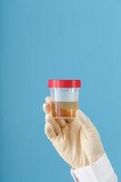 The doctor's gloved hand holds a transparent container with a urine test. photo