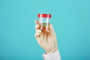 A container for biomaterial with a urine analysis in the hand of a doctor in a white rubber glove on a cyanic background. photo