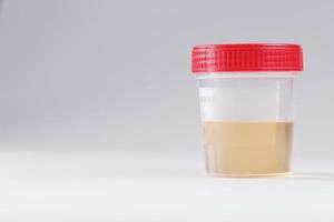 Plastic container with yellow urine analysis for detecting diseases. photo