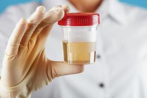 A doctor in a white coat holds a plastic container with yellow urine in his hand. photo