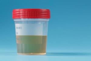 A container for biomaterials with a urine analysis and a red lid on a blue background. photo