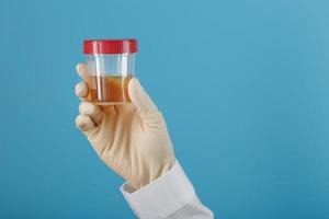 un recipiente para biomaterial con un análisis de orina en la mano de un médico con un guante de goma blanco sobre un fondo azul. foto