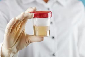 A doctor in a white coat holds a plastic container with yellow urine in his hand. photo