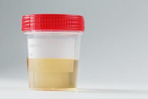 Urine in a jar with a red lid for laboratory analysis on a white background. photo