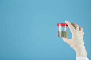 un recipiente para biomaterial con un análisis de orina en la mano de un médico con un guante de goma blanco sobre un fondo azul. foto