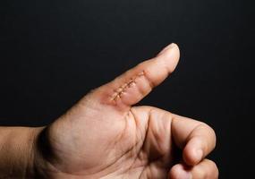 primer plano de una mano herida con puntos, herida en el pulgar sobre fondo negro. cicatriz, sutura, accidente foto