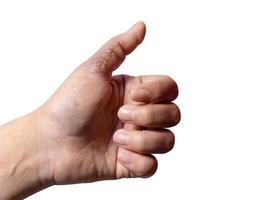 Close-up of a hand wound with stitches, thumb wound on white background. scar, suture, accident photo