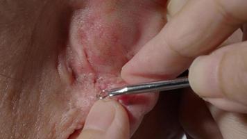 Squeezing blackhead pimple with stainless steel medical acne remover tool. video