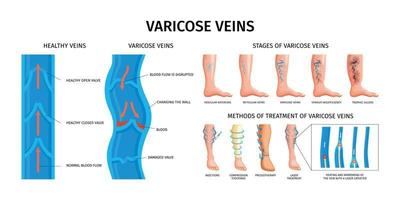 venas varicosas infografías realistas vector