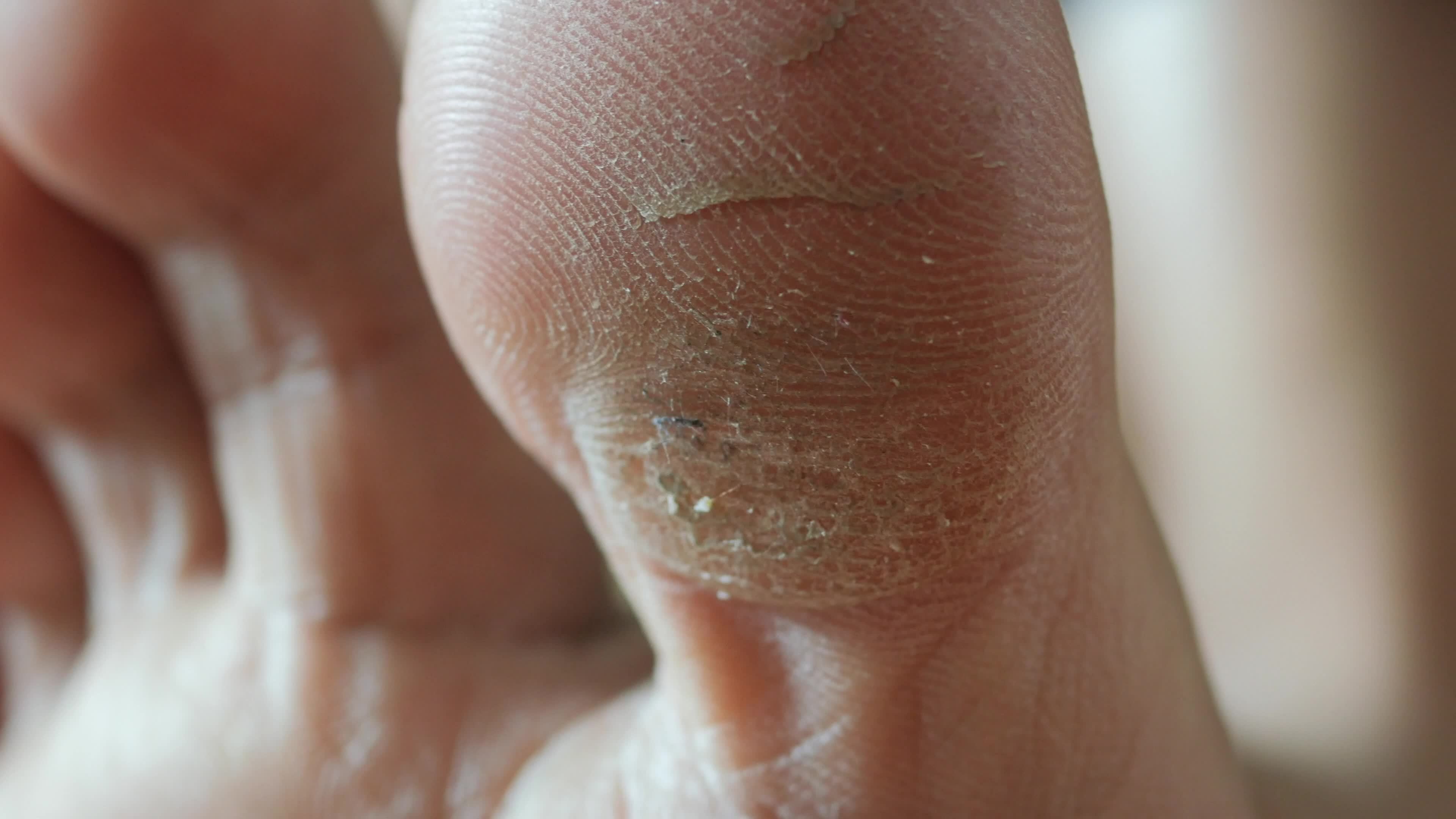 Close up of a toe callus 13571545 Stock Video at Vecteezy