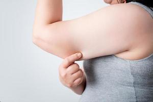 Excess fat under the arms of women who are overweight. Health care workers. photo