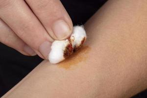 cauterización de una herida en el brazo con una solución de yodo y algodón, cuidado de la piel foto