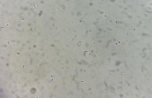 análisis de semen bajo microscopía que muestra piospermia o leucocitospermia. análisis de esperma foto