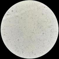 Semen analysis under microscopy showing Pyospermia or leukocytospermia. Sperm analysis. photo