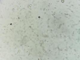 análisis de semen bajo microscopía que muestra piospermia o leucocitospermia. análisis de esperma foto