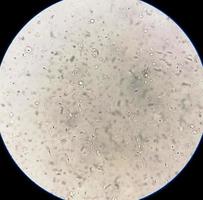 Semen analysis under microscopy showing Pyospermia or leukocytospermia. Sperm analysis. photo