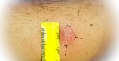 Vacunación mantoux, fotografía de vista de primer plano del brazo del paciente con reacción de mancha roja a la realización de la prueba mantoux. paciente tuberculoso positivo. foto