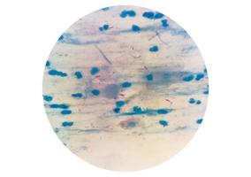 Sputum or phlegm smear AFB stain under microscopy showing Macrobacterium Tuberculosis Bacteria or MTB photo